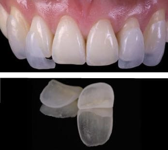 Carillas Dentales de Cerámica