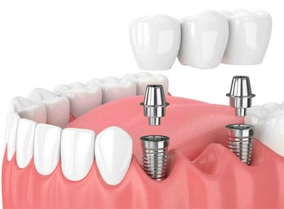 Colocacion Corona Implante