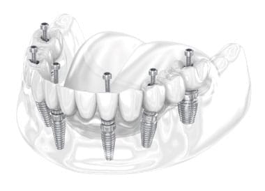 Implantes dentales