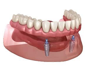 Sobre dentaduras Implanto-Retenidas