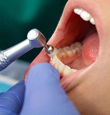 Restauración dental Restauración Dental