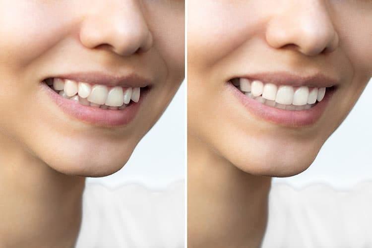 Carillas Dentales de Composite