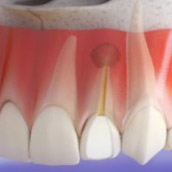 cirugia-apical