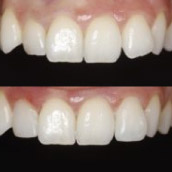 composite-thumb