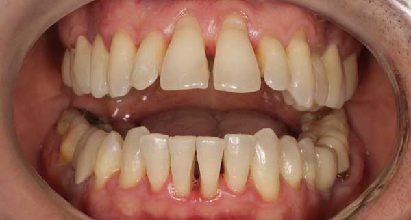 enfermedad-periodontal