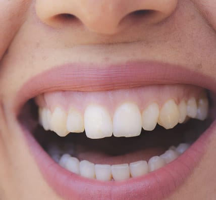 sonrisa-gingival