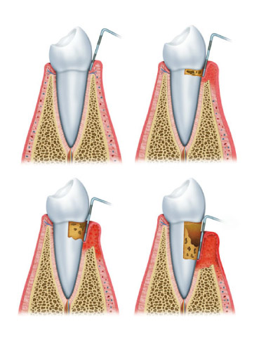 tratamiento-periodontal-2