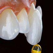 carillas-dentales-1
