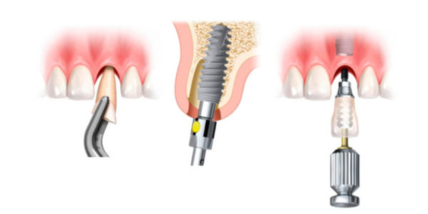 postextraccion-600×300