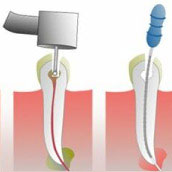 Endodoncia Palma de Mallorca