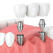 Implantes Dentales