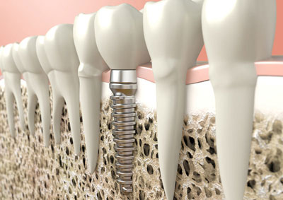 Osteointegración Implantes Dentales