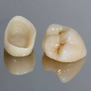 coronas-porcelana fundas dentales fijas