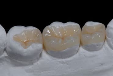 Fundas dentales fijas