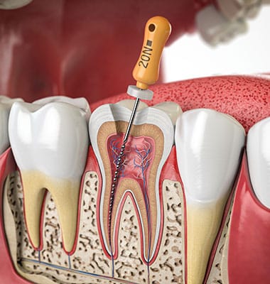 Endodoncia