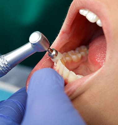 Restauración Dental