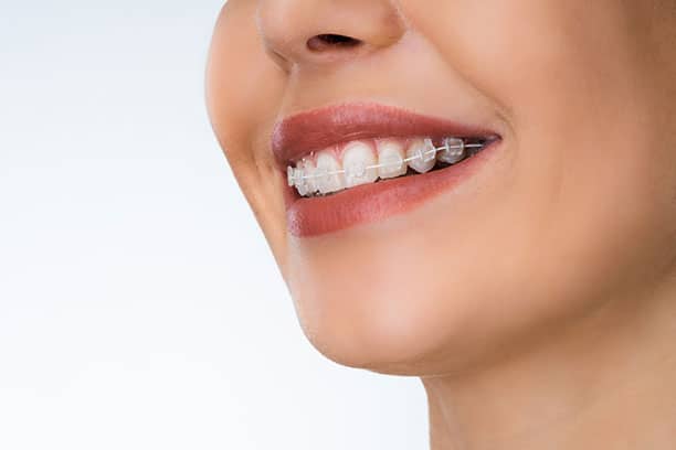 Brackets Zafiro Brackets Zafiro