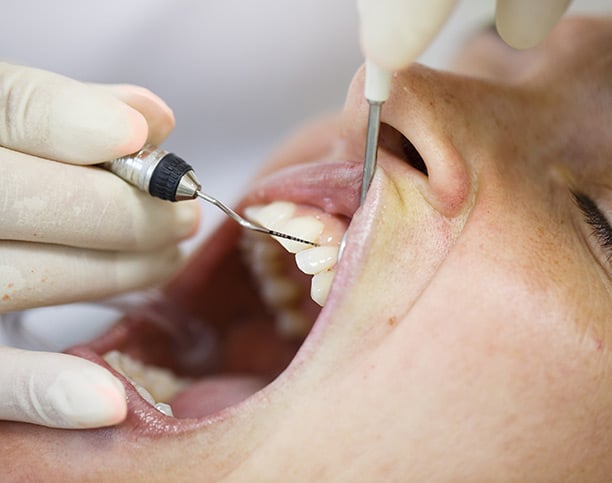 Estética Gingival Coronas e Incrustaciones Dentales